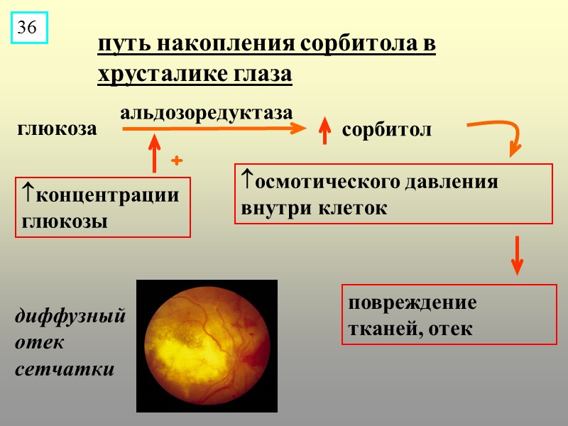 + глюкоза сорбитол  альдозоредуктаза путь накопления сорбитола в хрусталике глаза концентрации глюкозы осмотического